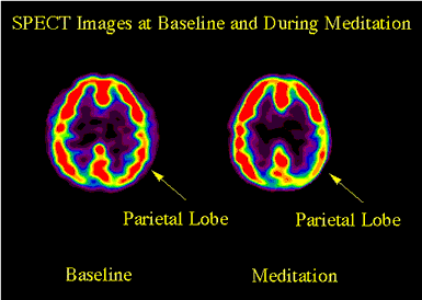 SPECT Images During Meditation