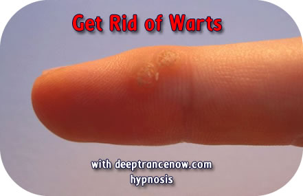 Get Rid of Warts