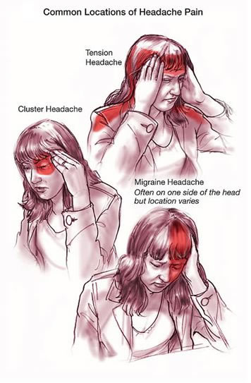 Migraine headache locations