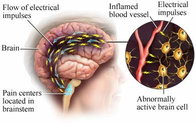 brain with migraine