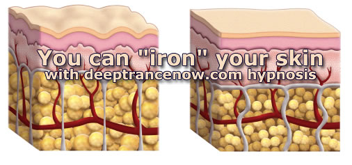 You can "iron" your skin with hypnosis