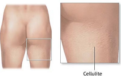 What is cellulite