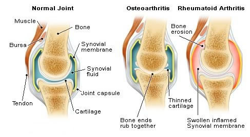 Ostheoarthritis