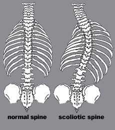 Scoliosis - Normal and scoliotic spine
